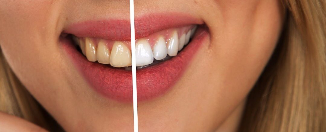 Teeth Bleaching Ratgeber: Empfehlung und Kaufratgeber